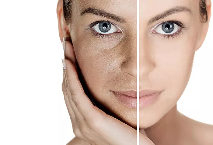 Manuka honey can help