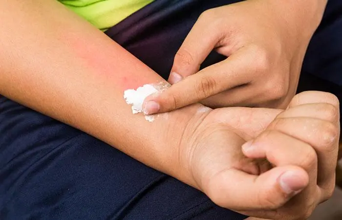 Use It To Heal Insect Bites
