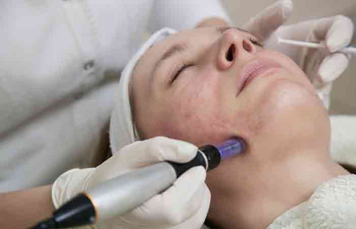 Woman getting a dermabrasion treatment to treat facial redness
