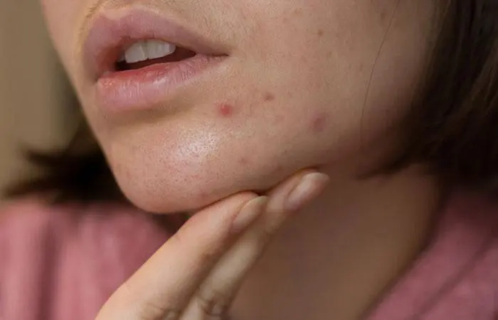 You Will Notice Frequent Acne All Over Your Face