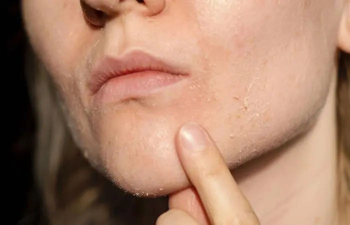 Cornstarch For Dry Skin