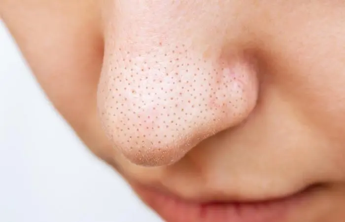 Cornstarch To Get Rid Of Blackheads