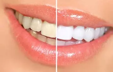 Can-You-Really-Use-Banana-Peels-To-Whiten-Your-Teeth2