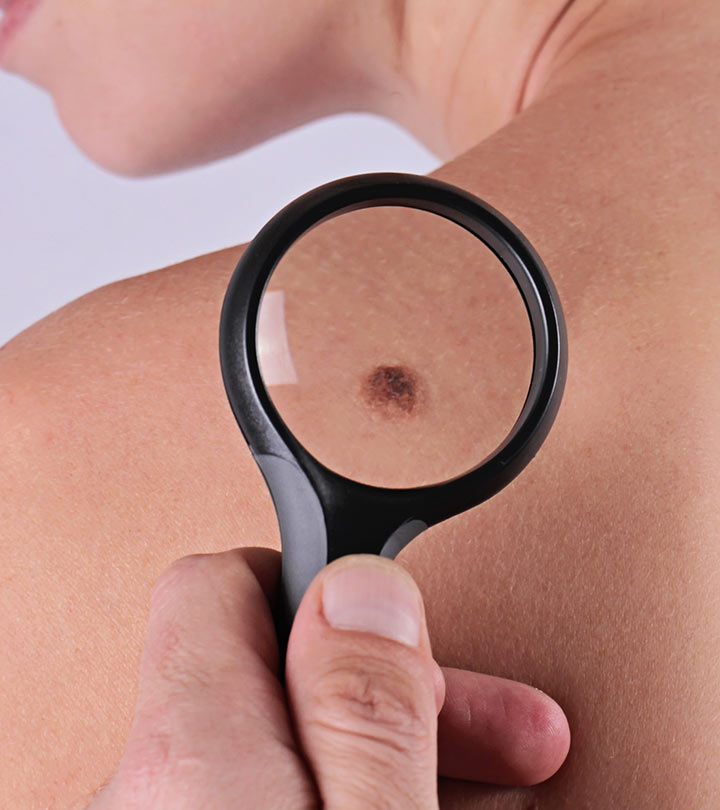 Rub This Natural Ingredient On Your Skin Tags And They Will Disappear In No Time!