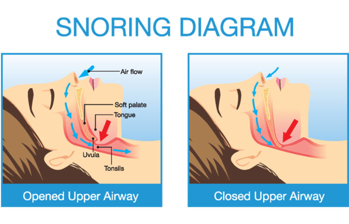 Easy-And-Natural-Way-To-Stop-Snoring
