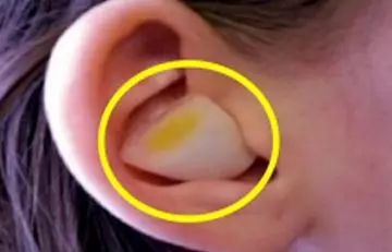 If You Put a Clove of Garlic in Your Ear, This Is What Will Happen2