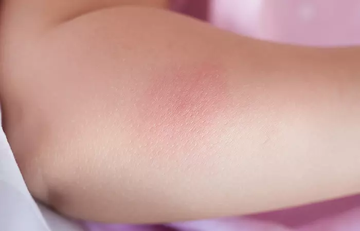 A-Perfect-Remedy-For-Itchy-Bug-Bites