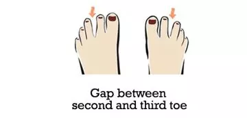 Gap-between-second-and-third-toe