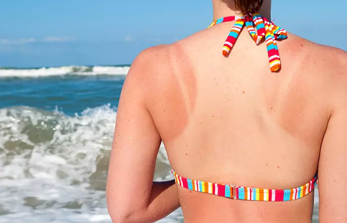 Treats Sunburns 