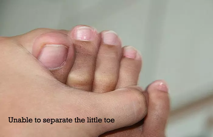 Unable to separate the little toe