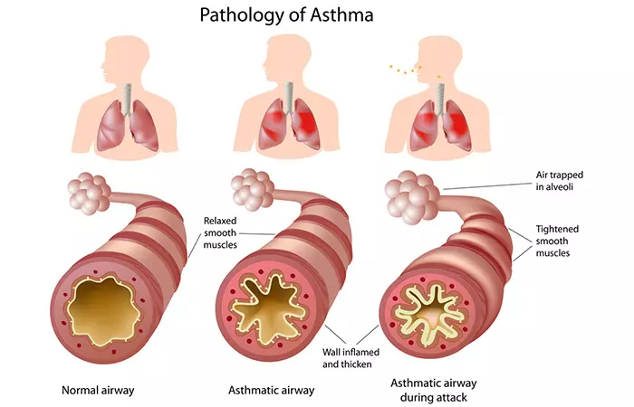3.-Asthma