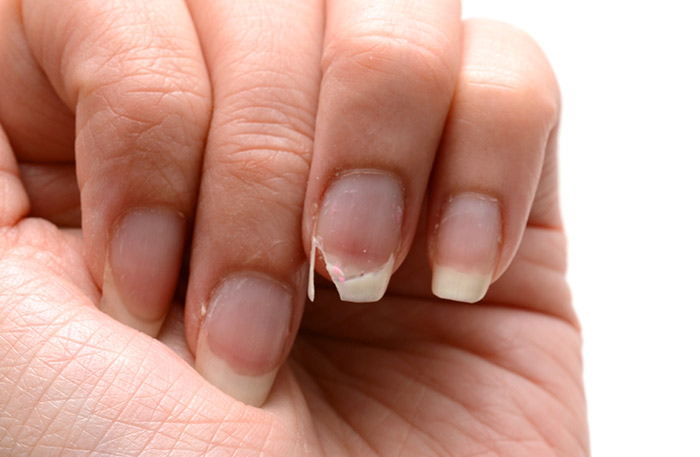 1. Chipping Nails