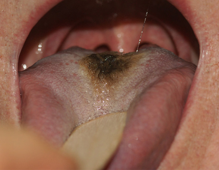 Black, Hairy Tongue – Tongue That Looks Black And Has Overgrown Papillae