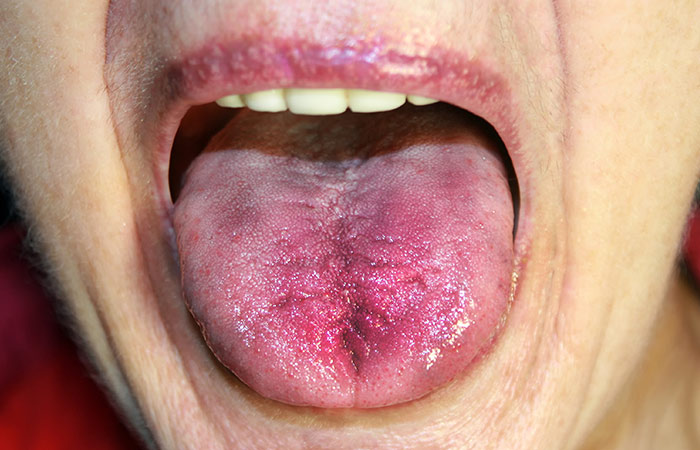 Tongue With Sores And Bumps