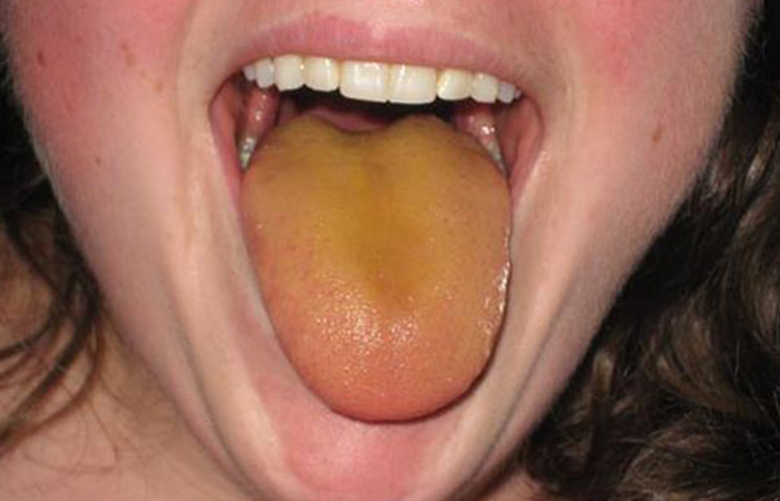 Yellow Tongue