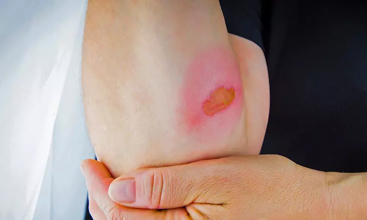 #4 Ouch! That Silly Bruise