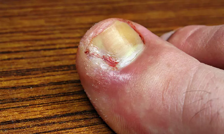 #8 What About Fingernail Fungus