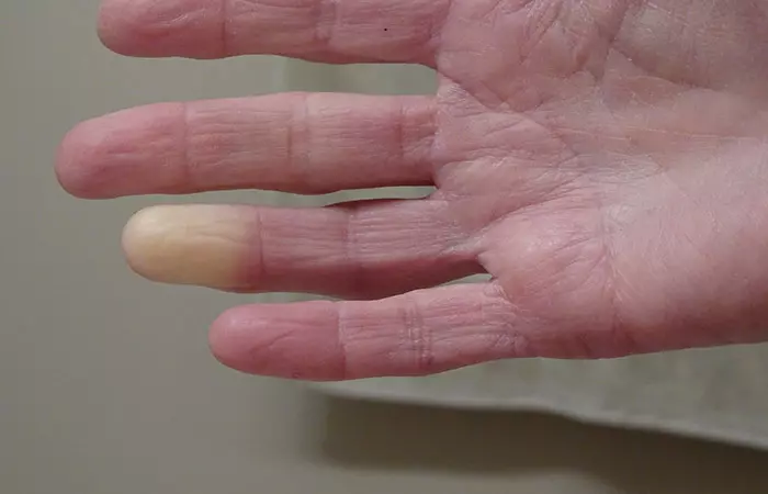 1. Raynaud’s Syndrome