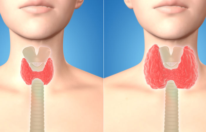 The Types Of Thyroid Diseases That Can Affect You