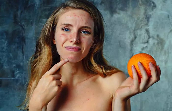 1. Fight Acne