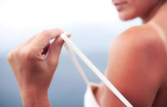 2. Soothe Some Sunburns