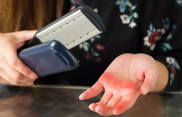5. Alleviate Minor Burns