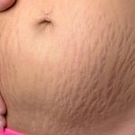 Rub This Oil On Your Stretch Marks And They Will Disappear In 30 Days