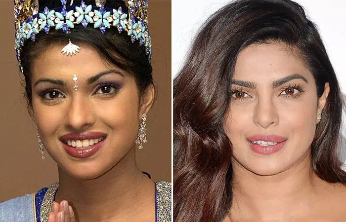 Priyanka Chopra before and after nose job