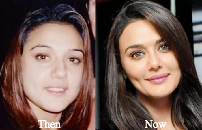 Preity Zinta before and after nose job
