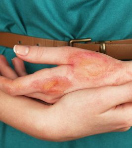 How To Treat Burns At Home - 13 Natur...