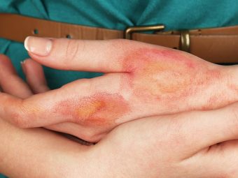 13 Remedies To Treat Burns At Home