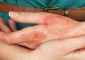 How To Treat Burns At Home - 13 Natur...