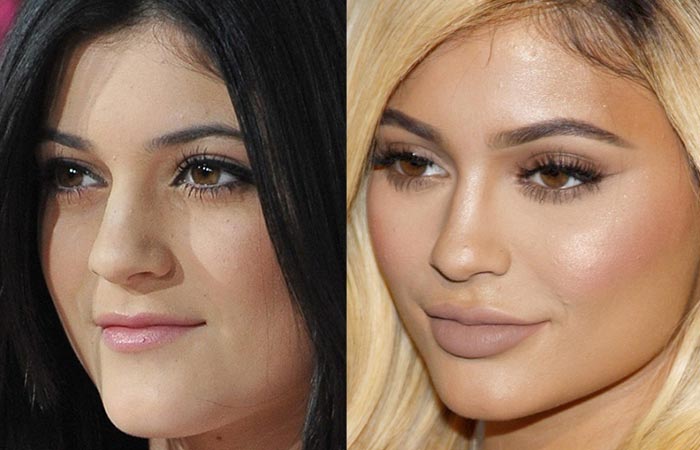 Kylie Jenner before and after nose job