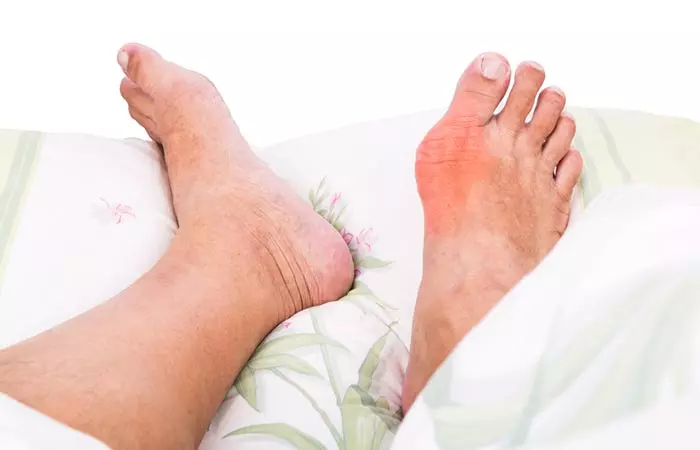 2. Gout