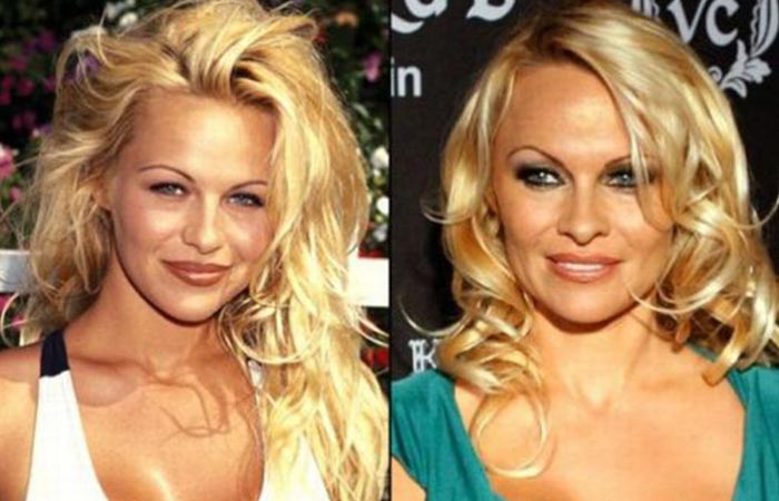 Pamela Anderson before and after nose job
