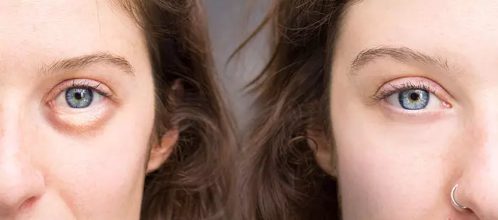 3.For Getting Rid Of Dark Circles