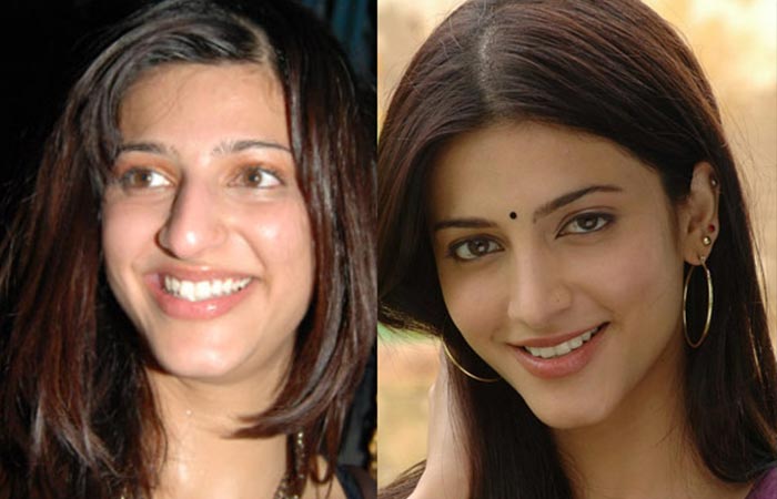 Shruti Hassan before and after nose job