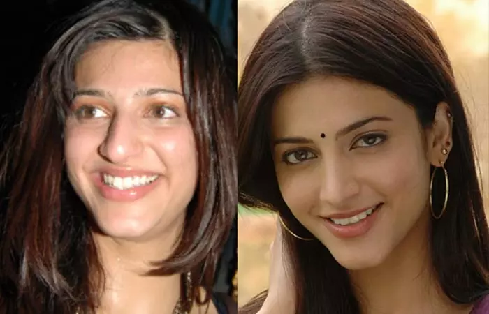 Shruti Hassan before and after nose job