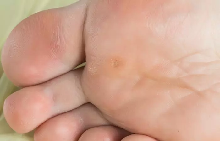 7. Calluses