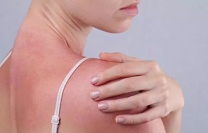 9.For Treating Sunburns