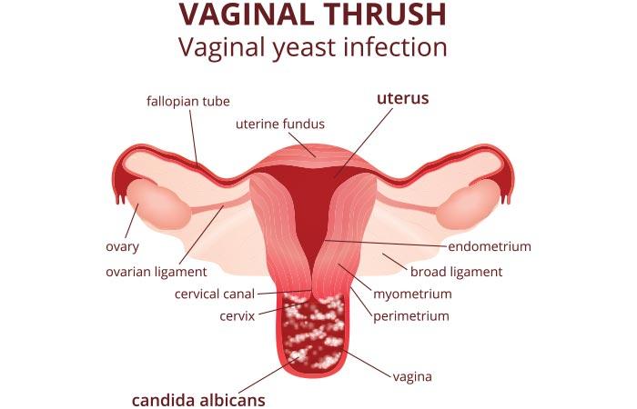But First, Vaginal Yeast Infection – What’s That?