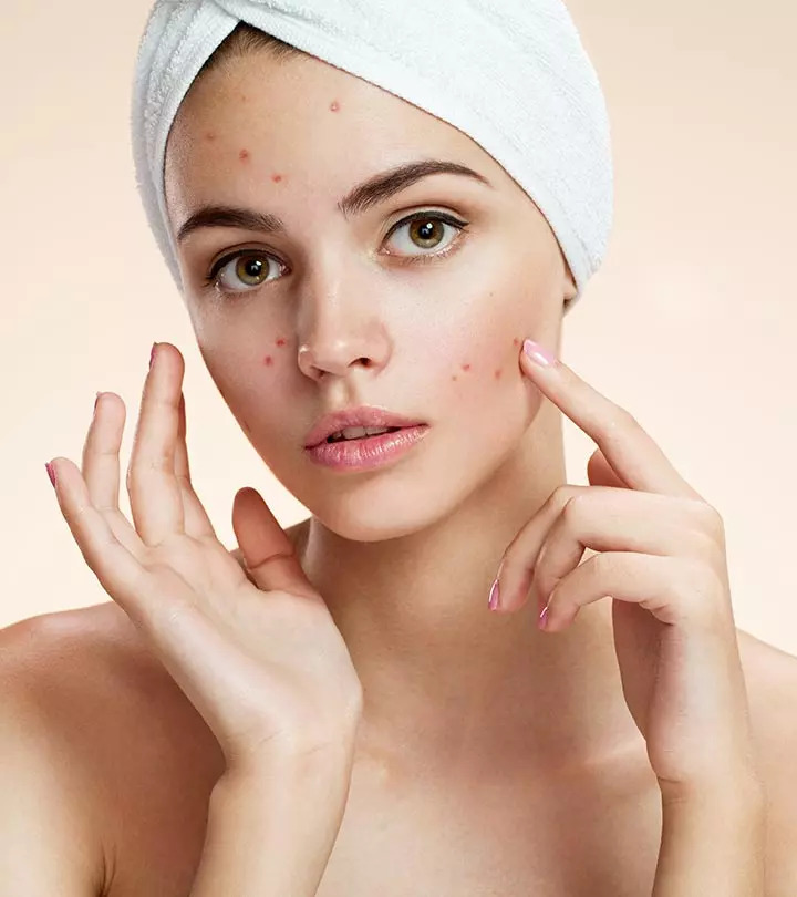 7 maneiras simples de usar o peróxido de hidrogênio para tratar a acne