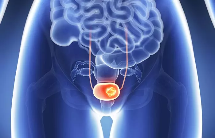 8. Pelvic Growths