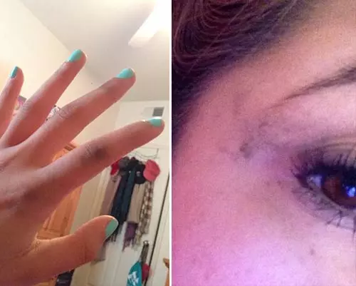11. Raccoon eyes Almost every day. 