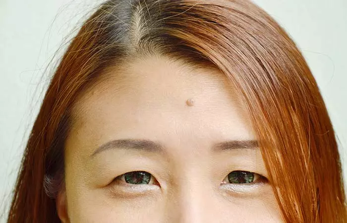 2. Mole On Your Forehead