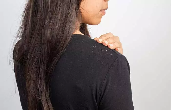 8. Dandruff Is Contagious