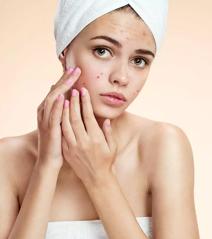 Acne-Myths-You-Need-to-Stop-Believing