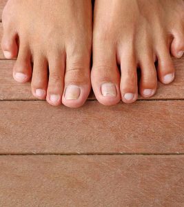 10 Remedies To Get Rid Of Ingrown Toe...