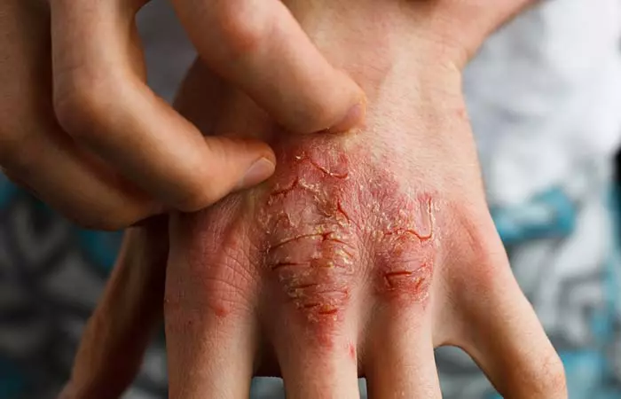 2. Itchy Skin With Scars 