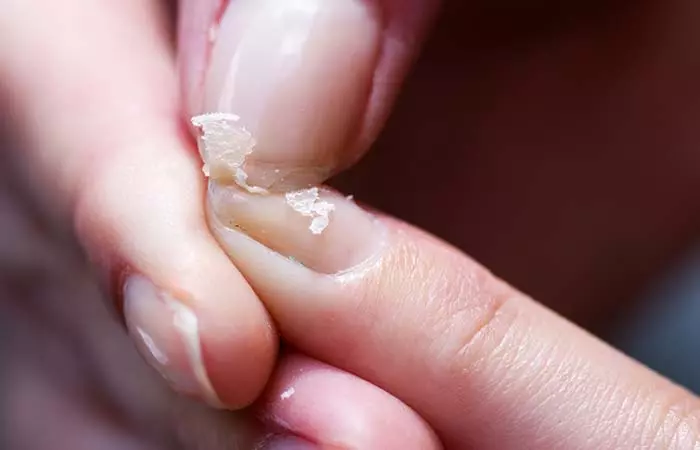 3. Brittle & Weak Nails 